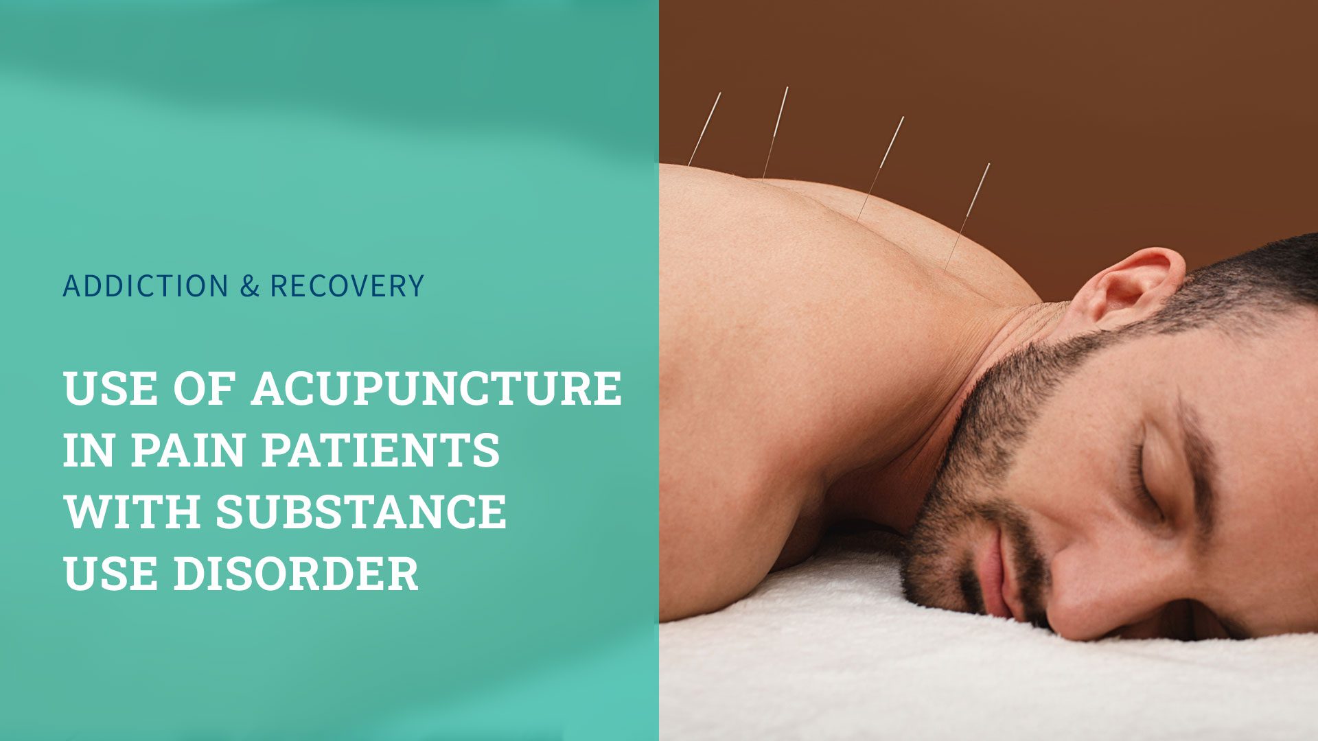 man lying on acupuncture table with needles in his back